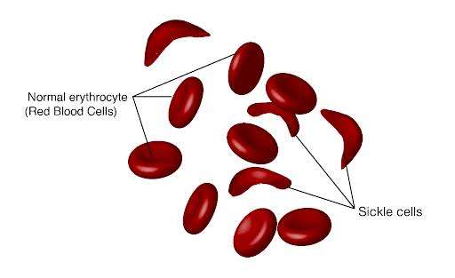 Sickle-shaped red blood cells contrasted with normal round cells